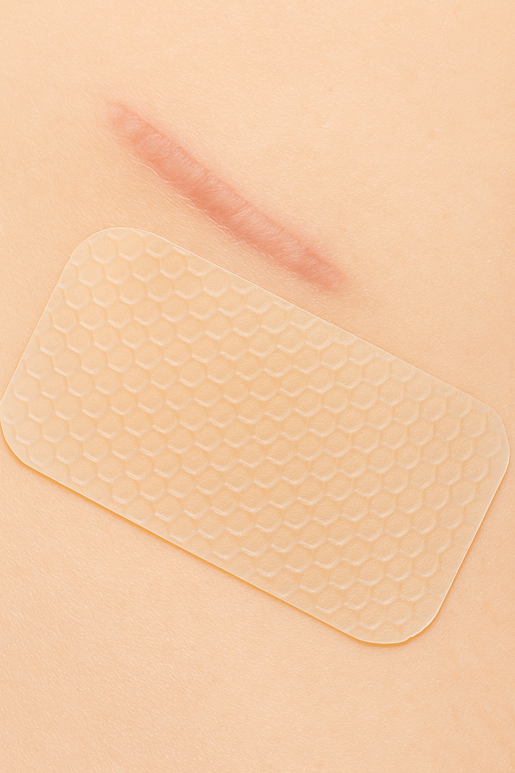Silicone Scar Sheets – Fade Scars Fast & Flawlessly (2-Pack)