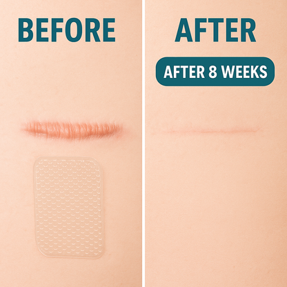 Silicone Scar Sheets – Fade Scars Fast & Flawlessly (2-Pack)